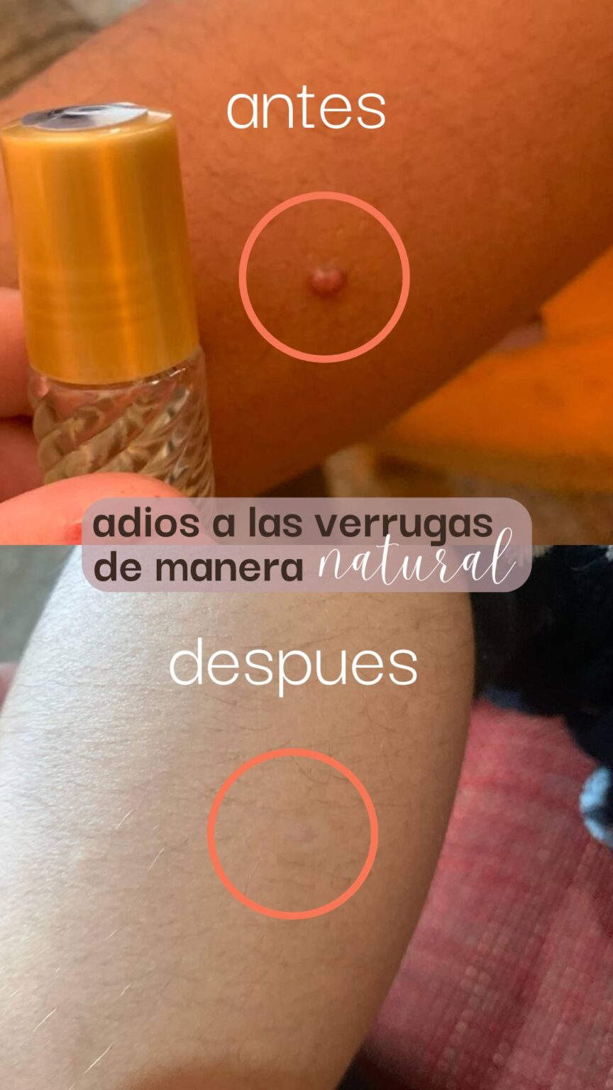 metodo natural para eliminar verrugas